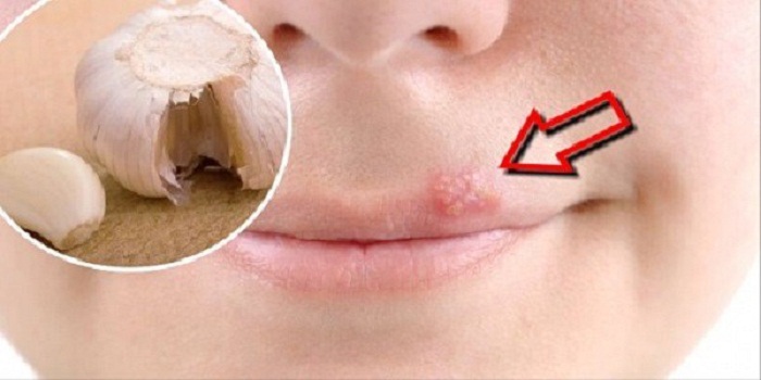 With Hydrogen Peroxide, Wart Removal Is Easier Than Ever