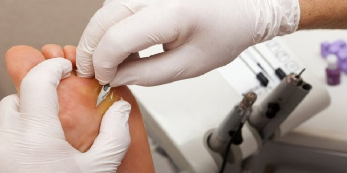 What Is The Best Wart Remover
