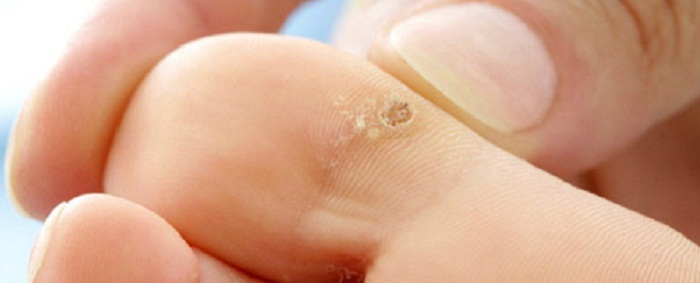 Home Remedies For Wart Removal