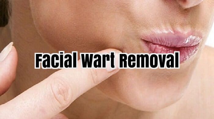 Facial Wart Removal