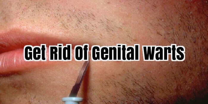 Get Rid Of Genital Warts