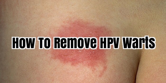 How To Remove HPV Warts