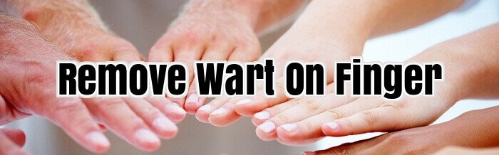 Remove Wart On Finger