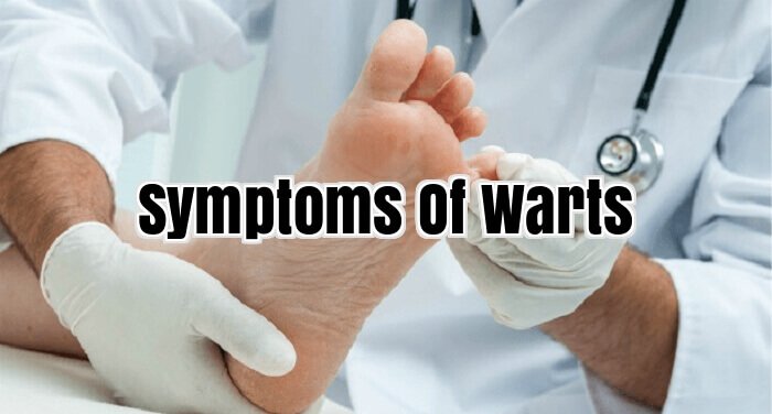 Symptoms Of Warts