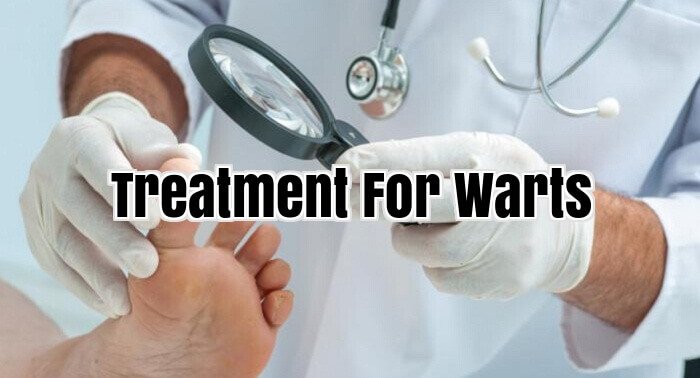 Treatment For Warts