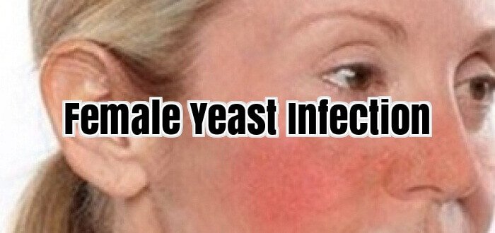 Female Yeast Infection