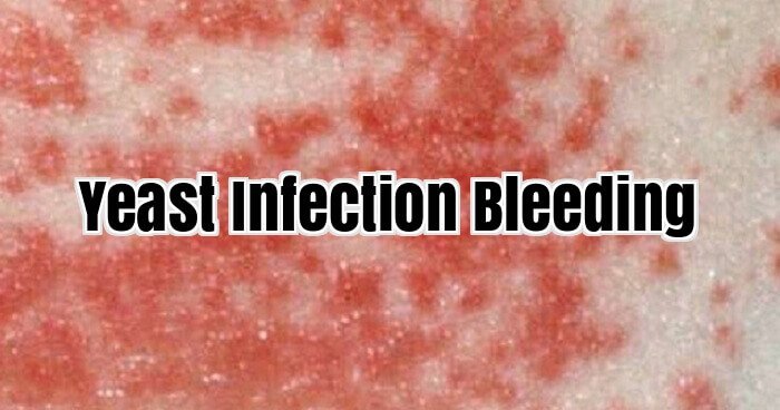 Yeast Infection Bleeding