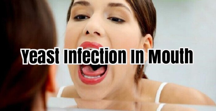 Yeast Infection In Mouth