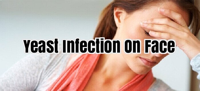 Yeast Infection On Face