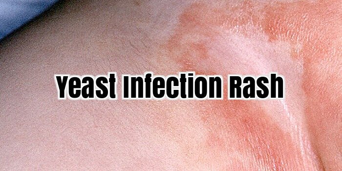 Yeast Infection Rash