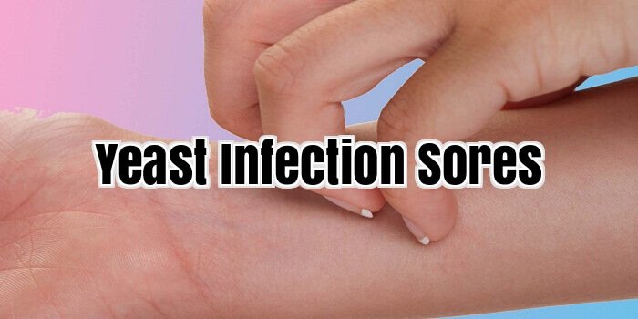 Yeast Infection Sores